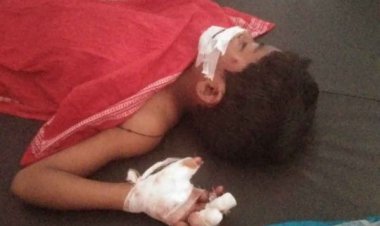पटाखा छोड़ते वक्त बालक बुरी तरह झुलसा, पहुंचा अस्पताल