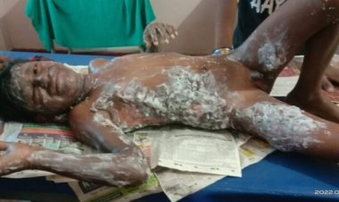 खौलती तेल की कड़ाही में गिरा सत्यम, इलाज में गरीबी आ रही आड़े, सुध लेने वाला कोई नहीं