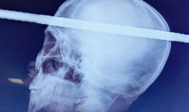 Flores Hospital performs Marathon Surgery to save the life of a laborer