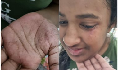 आवारा कुत्तों के हमले में छात्रा घायल