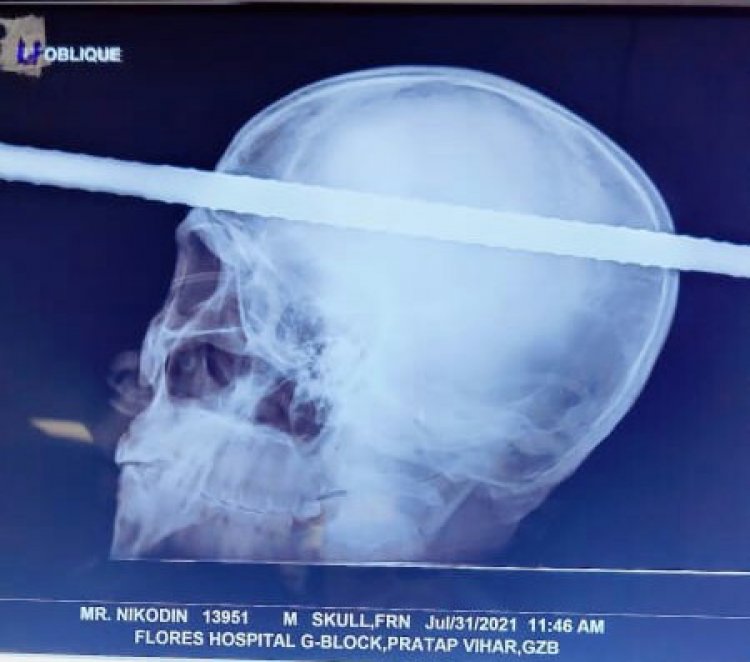 Flores Hospital performs Marathon Surgery to save the life of a laborer