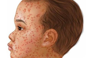 मीजल्स-रूबेला से बचाव को विशेष टीकाकरण अभियान आज से तीन चक्रों में चलेगा