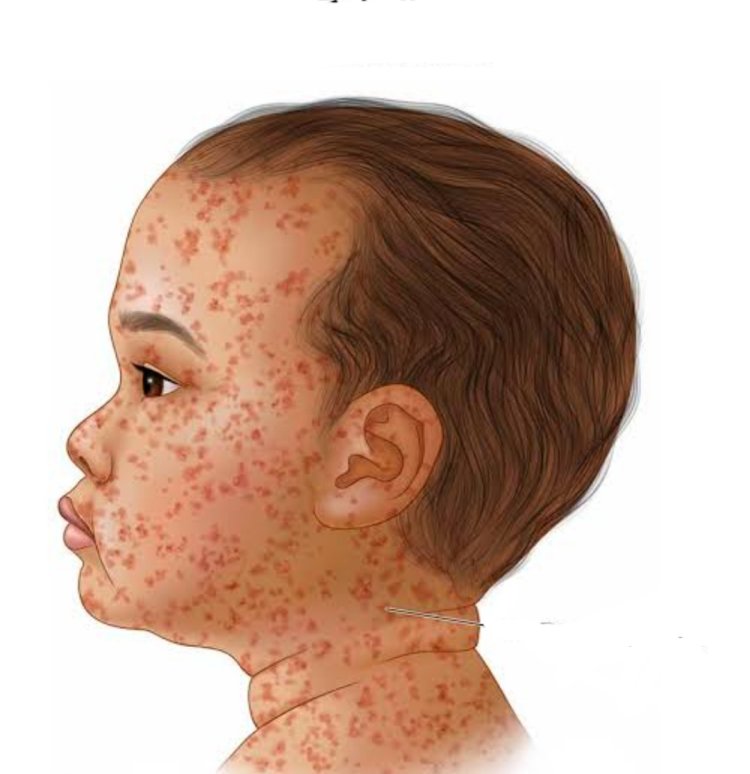 मीजल्स-रूबेला से बचाव को विशेष टीकाकरण अभियान आज से तीन चक्रों में चलेगा